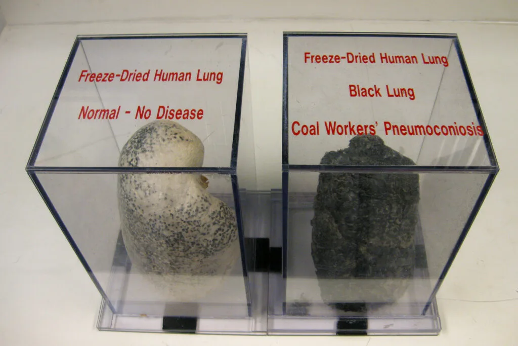 On the left is a light-colored freeze-dried human lung with a sign that says "normal - no disease." On the right is a dark, shriveled freeze-dried human lung with a sign that says "black lung" and "coal workers' pneumoconiosis."