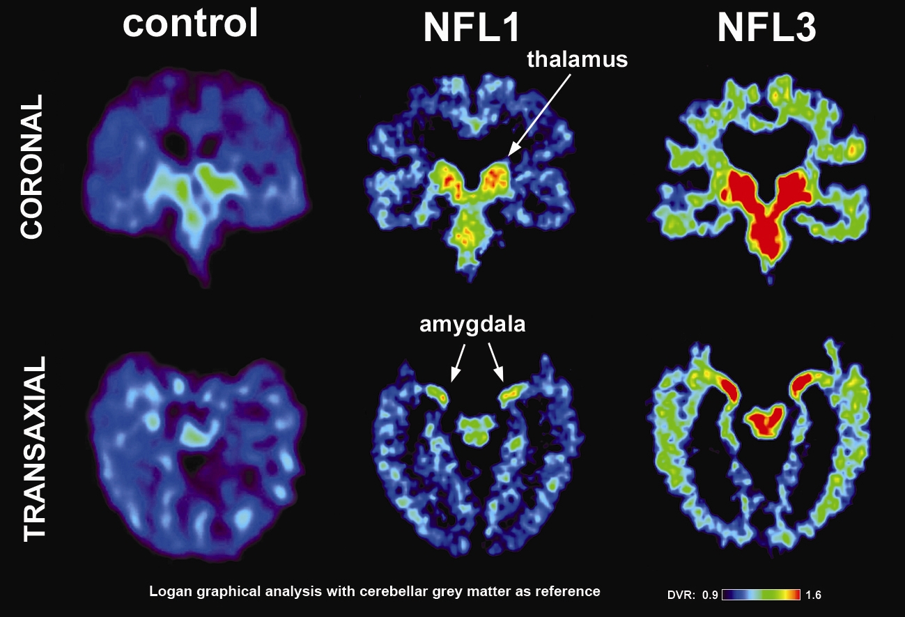 New Study Finds Brain Damage in Living Ex-NFL Players