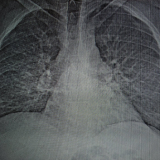 A CT scan shows the damage to Danny Smith's lungs caused by progressive massive fibrosis.