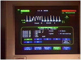 Image from show: closeup of monitor, showing change in heartbeat