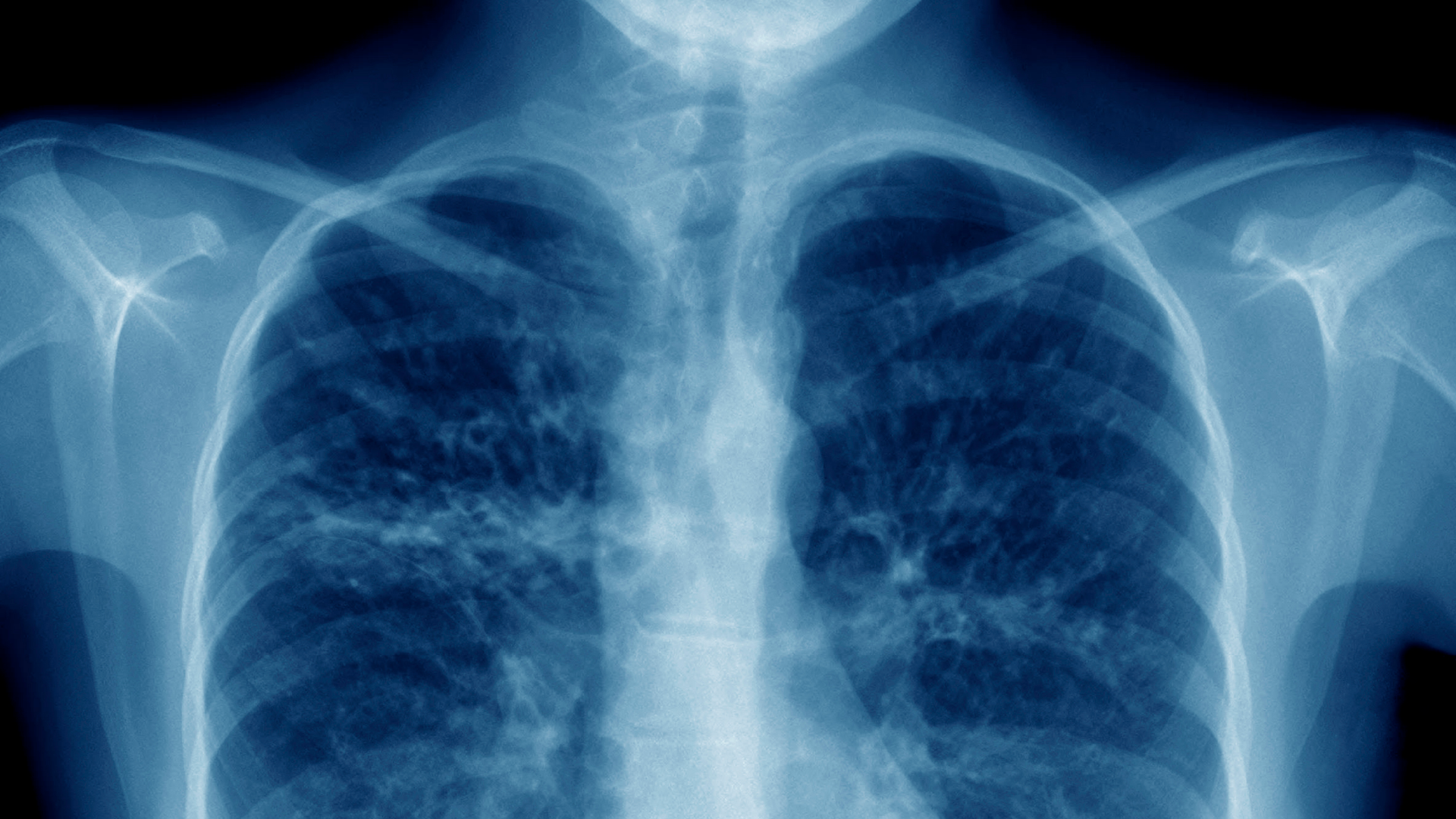 Xray of human chest
