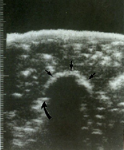 ultrasound of a frozen lesion in a liver