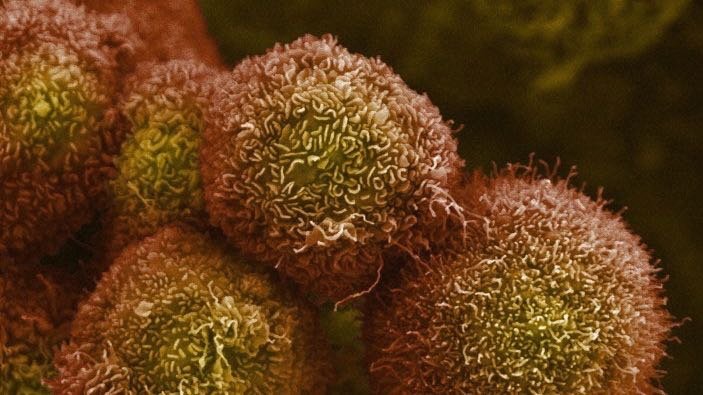 pancreatic cancer cells